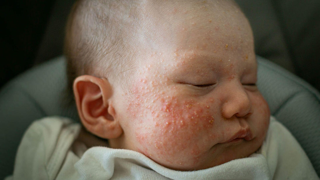 acne neonatale