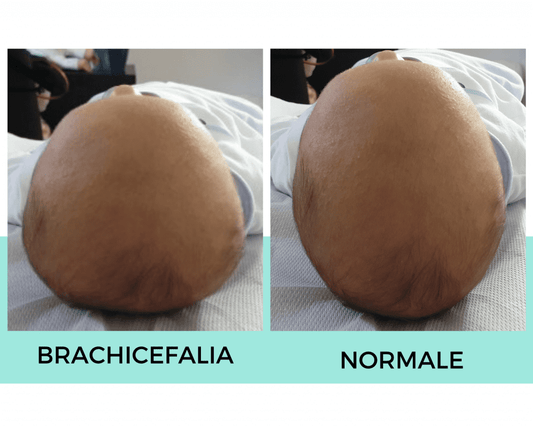 brachicefalia posizionale neonato