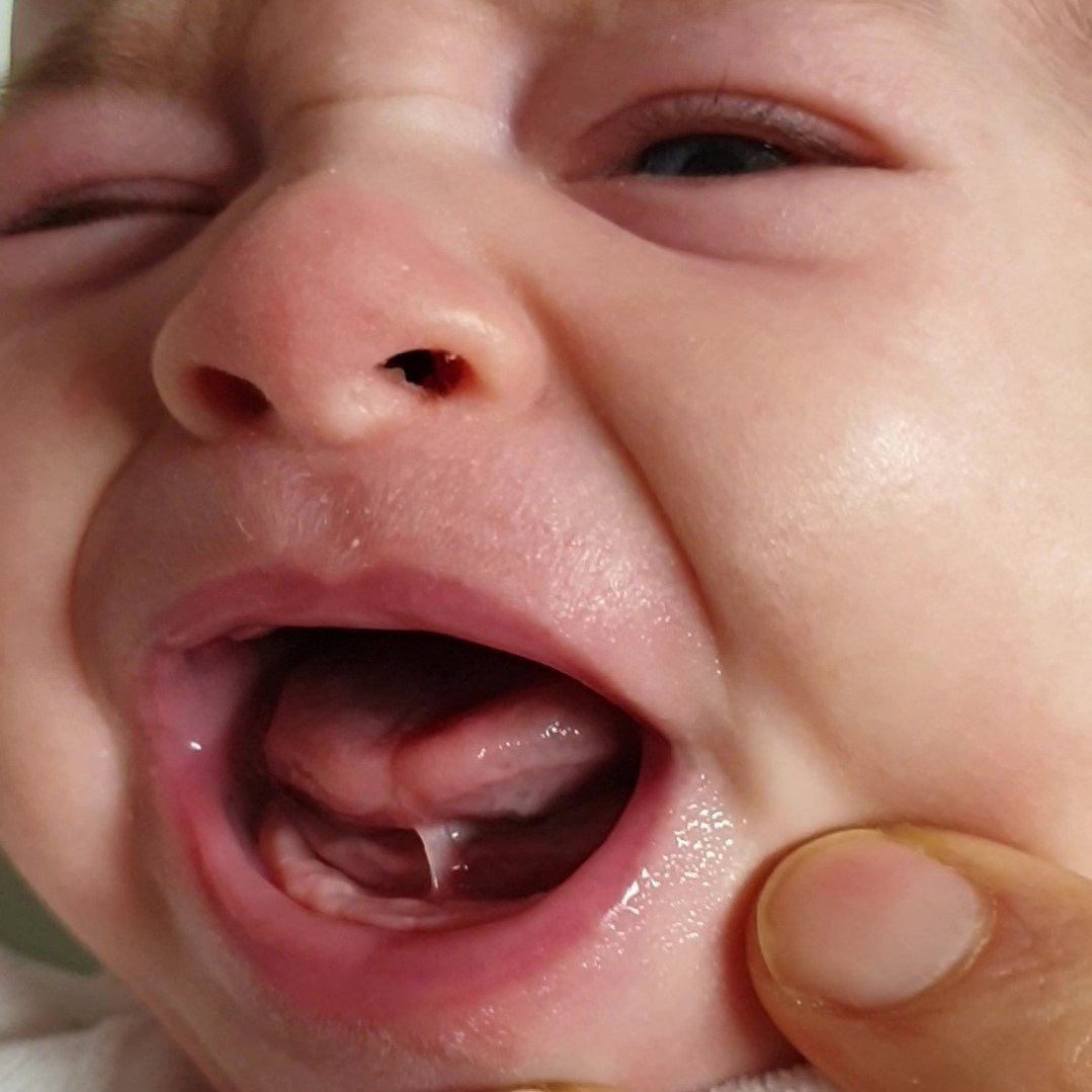 frenulo linguale corto nel neonato