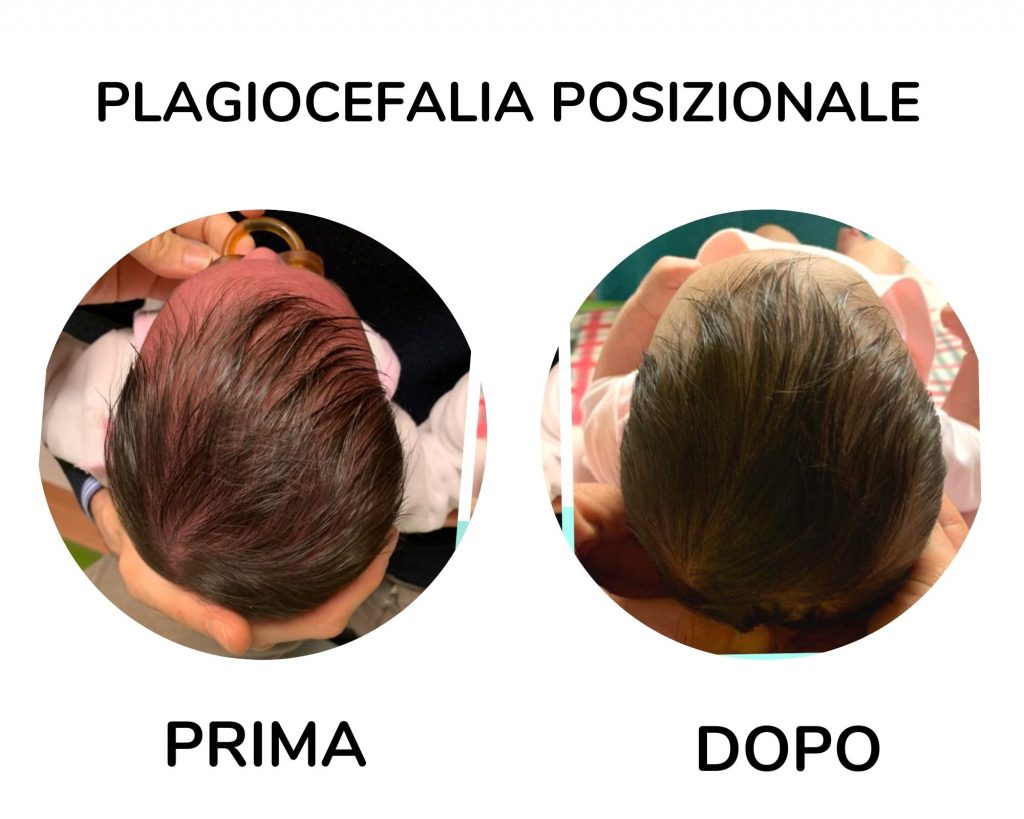 plagiocefalia non si cura da sola